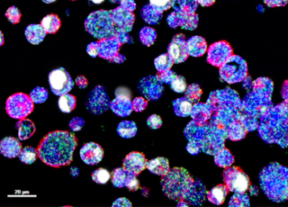 Sénescence et plasticité des cellules cancéreuses : une relation à haut risque